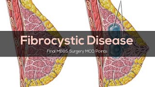 Breast Disorders 4  Fibrocystic Disease  Final MBBS Surgery MCQ Points [upl. by Irod]