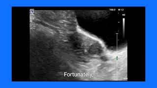 Fibroid vs LSCS Scar Dehiscence How Ultrasound and Doppler Make the Diagnosis [upl. by Celka957]