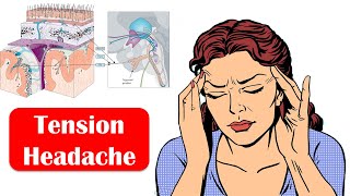 Tension Headache  Causes Signs amp Symptoms And Treatment [upl. by Aikemat]