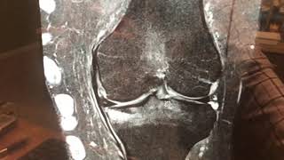 MRI Findings of a Medial Meniscus Root TearDr Mora [upl. by Anana]