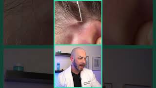 Doctor reacts to impacted ingrown hair removal dermreacts doctorreacts ingrownhair [upl. by Dix]