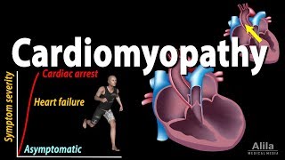 Cardiomyopathy animation [upl. by Bowyer709]