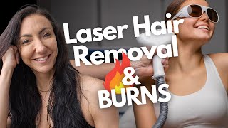 Laser Hair Removal Burns Causes Prevention and Treatment Tips [upl. by Yalc]