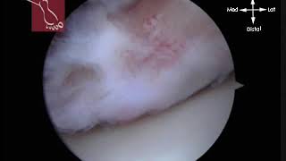 Removal of Osteophyte of Anterior Tibial Rim [upl. by Mohl]