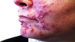 Cystic acne and scarring acne [upl. by Willmert18]