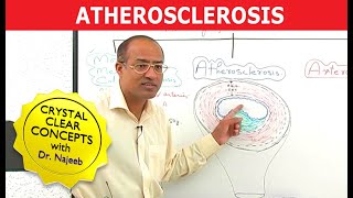 Atherosclerosis  Pathophysiology [upl. by Stephenson980]