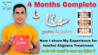 4 Months Complete My Invisible Aligner  Invisible Braces 45000₹ in India  Toothsi Results [upl. by Kcirddot]