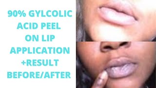 90 GYLCOLIC ACID PEEL CHEMICAL PEEL ON LIP APPLICATION RESULTSCHEMICAL PEEL  BEFORE AND AFTER [upl. by Nonnahsed418]