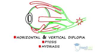 Ophthalmology – Diplopia By Martin ten Hove MD [upl. by Nnaylime896]