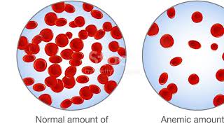 Etiopathogenic Classification of anemia  Anemia of Acute or Chronic Bleeding 02 [upl. by Dnanidref]