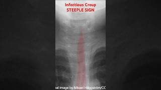 Infectious Croup Xray Steeple Sign [upl. by Naquin]