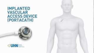 PortaCath Implanted Vascular Access Device [upl. by Aleda]