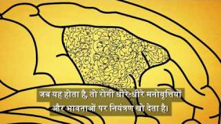 What is Alzheimers Disease Hindi [upl. by Ebba]