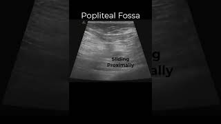 Popliteal Sciatic Nerve Block emergencymedicine regionalanesthesia POCUS FOAMed FOAMus [upl. by Akili]