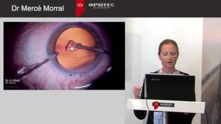 Astigmatism Management in Cataract Surgery with a new Aspheric Toric IOL by Dr Mercé Morral [upl. by Anyzratak793]