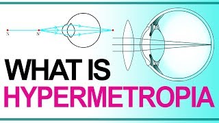 What is Hypermetropia  Causes  Correction for Hypermetropia  Defects of Vision  Grade10 Physics [upl. by Ollopa]