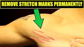 How To Get Rid Of Stretch Marks  4 Easy Tips To REMOVE STRETCH MARKS [upl. by Nylirehc]