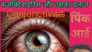 Viral conjunctivitis  Ka Ilaj Kaise Kare  pink eye  conjunctivitis treatment  itchy eyes [upl. by Robison]