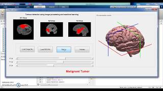 Detect tumor from brain MRI using matlab [upl. by Elsey700]