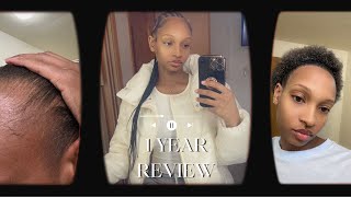 1 YEAR HAIR TRANSPLANT REVIEW GOT MY HAIR BRAIDED FIRST TIME IN YEARS WILL I GO BACK TO LONGEVITA [upl. by Clem959]