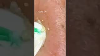 Pickel Ausdrücken Blackheads Akne amp Mitesser entfernen 🔴 24 [upl. by Arlon108]