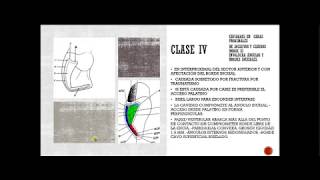 Clasificación de las cavidades dentales según Dr Black y la NUEVA ADICION CLASE VI [upl. by Ahsennod]