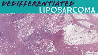 Dedifferentiated liposarcoma with heterologous osteosarcoma component [upl. by Panthea]