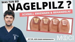 Nagelpilz schnell erkennen amp behandeln Das hilft [upl. by Taite]