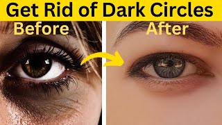 Say Goodbye to Dark Circles Natural Remedies to Get Rid of Under Eyes Dark Circles [upl. by Assiral]