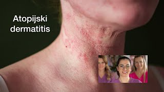 Rešen atopijski dermatitis uz pomoć aktivnog kiseonika Viva by Ela [upl. by Woodford]