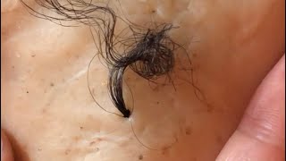 Removal of ingrown hair [upl. by Zinah635]