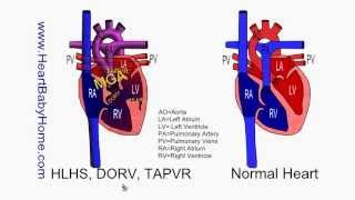 58  HLHS DORV TAPVR with Glenn and Fontan [upl. by Anolahs]