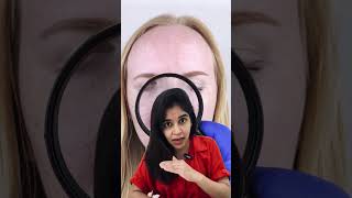 Pigmentary Demarcation Lines dermatologist dranvika transformation [upl. by Ahsinnod641]