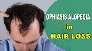 OPHIASIS ALOPECIA in HAIR [upl. by Roshan580]