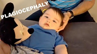 HOW WE FIXED OUR BABYS HEAD WITHOUT A HELMET Plagiocephaly [upl. by Akissej825]