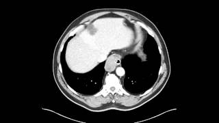 Esophageal leiomyoma of distal esophagus Chest CT [upl. by Bullard]