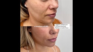 Botox in Los Angeles CA  Skin Tightening Botox and Lip Fillers by Skinsation LA [upl. by Trakas]