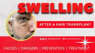 How to prevent swelling after hair transplant  My Comprehensive Guide [upl. by Fayina]