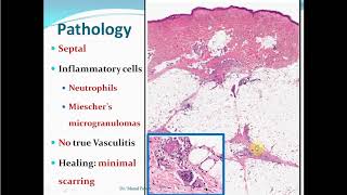 Panniculitis part 1 [upl. by Llyrpa]