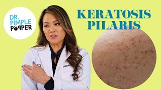 Ask Dr Pimple Popper  Keratosis Pilaris aka Chicken Skin [upl. by Kitty]