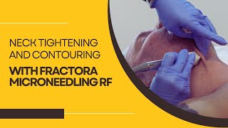 Neck Tightening and Contouring with Fractora Microneedling RF [upl. by Aihsoek445]