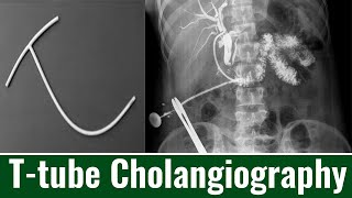 Ttube Cholangiography When is Ttube Cholangiography Performed Cholangiogram Purpose amp Procedure [upl. by Idnis802]