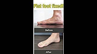 fix flat feet best exercises shorts flatfeet [upl. by Charles]