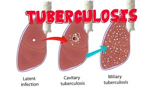 Different Forms of Tuberculosis [upl. by Raddatz]