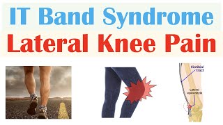 Iliotibial IT Band Syndrome Common Cause of Lateral Knee Pain  Symptoms Diagnosis Treatment [upl. by Fedora896]