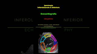 Ecocardiografia  Ipocinesia Inferolaterale E Inferiore [upl. by Gnilrets]