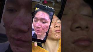 loan nguyen acne treatment amp Dr Lee pimple Popper Blackhead blackheads [upl. by Aligna]