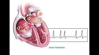 Atrial Fibrillation  Definition Causes Symptoms Diagnosis Treatment [upl. by Nehr652]