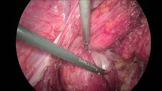 Laparoscopic Excision of a sacrococcygeal teratoma [upl. by Claudina595]