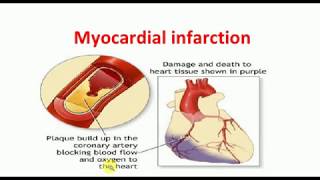 MEDICINE LECTURES  Cardiology Lectures  ACUTE MYOCARDIAL INFARCTION [upl. by Stalder]